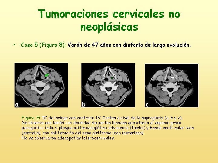 Tumoraciones cervicales no neoplásicas • Caso 5 (Figura 8): Varón de 47 años con