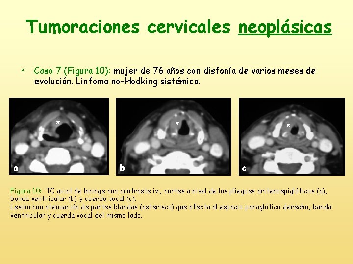 Tumoraciones cervicales neoplásicas • Caso 7 (Figura 10): mujer de 76 años con disfonía