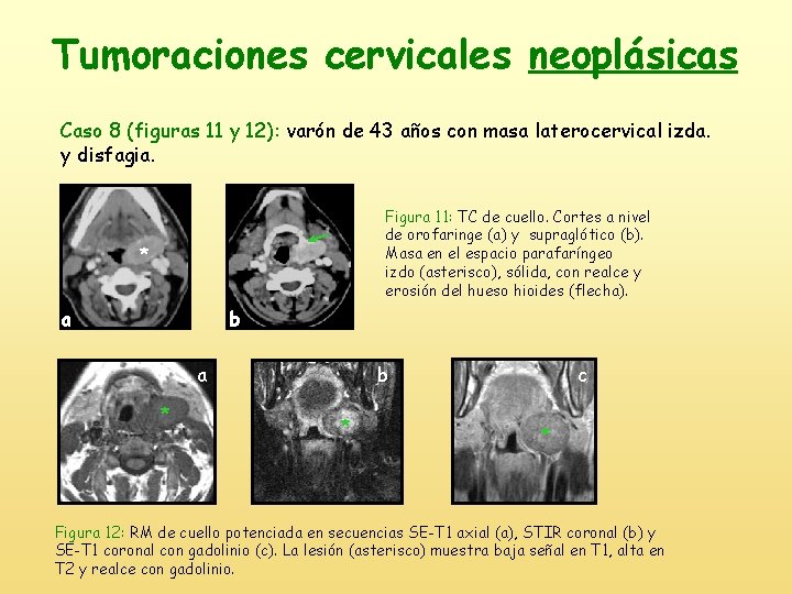 Tumoraciones cervicales neoplásicas Caso 8 (figuras 11 y 12): varón de 43 años con