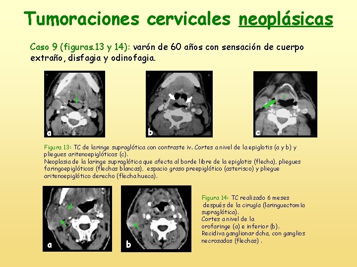 Tumoraciones cervicales neoplásicas Caso 9 (figuras. 13 y 14): varón de 60 años con