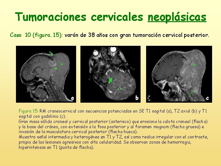 Tumoraciones cervicales neoplásicas Caso 10 (figura. 15): varón de 38 años con gran tumoración