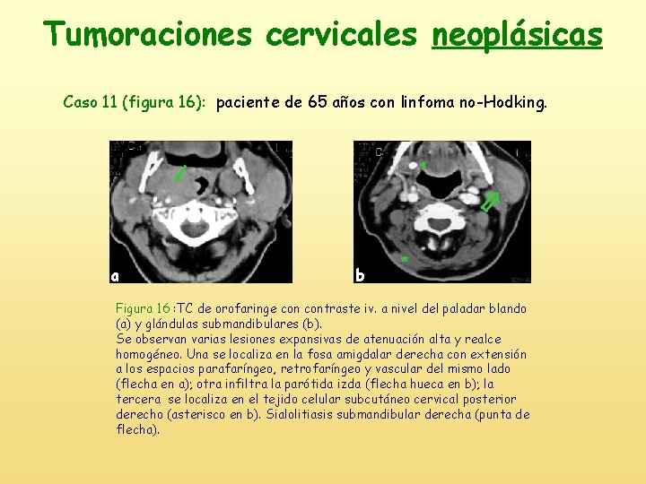 Tumoraciones cervicales neoplásicas Caso 11 (figura 16): paciente de 65 años con linfoma no-Hodking.