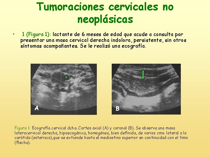 Tumoraciones cervicales no neoplásicas • 1 (Figura 1): lactante de 6 meses de edad