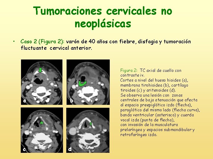 Tumoraciones cervicales no neoplásicas • Caso 2 (Figura 2): varón de 40 años con