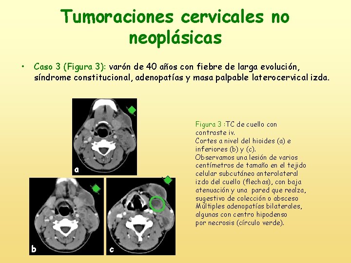 Tumoraciones cervicales no neoplásicas • Caso 3 (Figura 3): varón de 40 años con
