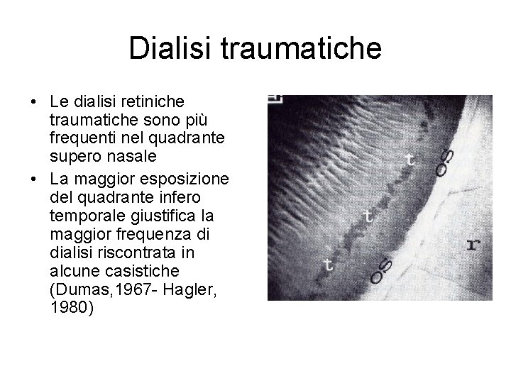 Dialisi traumatiche • Le dialisi retiniche traumatiche sono più frequenti nel quadrante supero nasale
