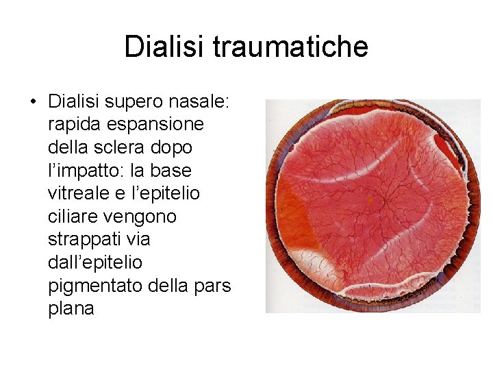 Dialisi traumatiche • Dialisi supero nasale: rapida espansione della sclera dopo l’impatto: la base