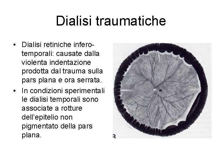 Dialisi traumatiche • Dialisi retiniche inferotemporali: causate dalla violenta indentazione prodotta dal trauma sulla