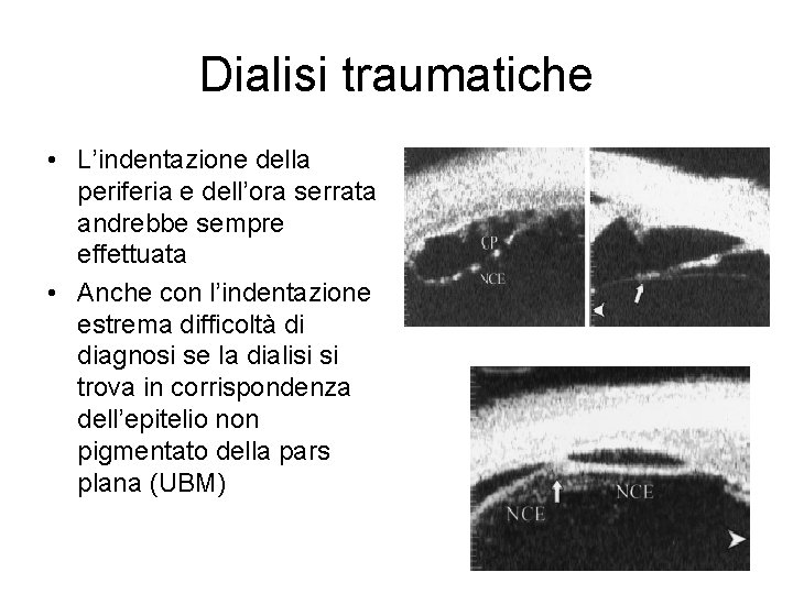 Dialisi traumatiche • L’indentazione della periferia e dell’ora serrata andrebbe sempre effettuata • Anche