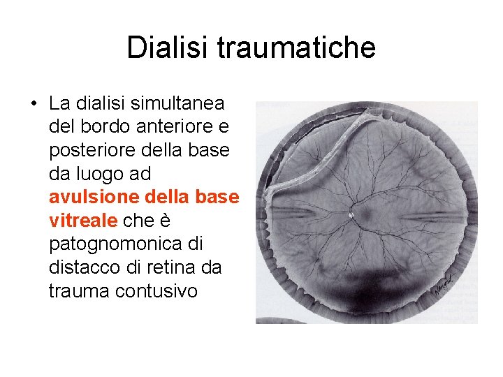 Dialisi traumatiche • La dialisi simultanea del bordo anteriore e posteriore della base da