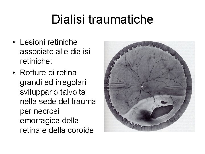 Dialisi traumatiche • Lesioni retiniche associate alle dialisi retiniche: • Rotture di retina grandi