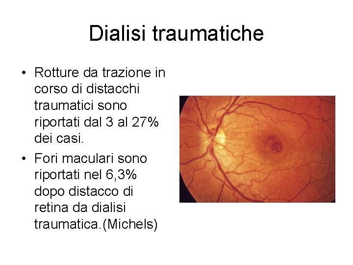 Dialisi traumatiche • Rotture da trazione in corso di distacchi traumatici sono riportati dal