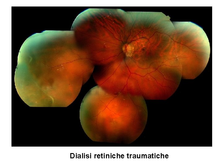 Dialisi retiniche traumatiche 