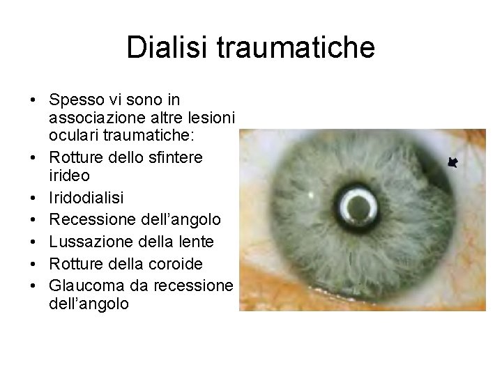 Dialisi traumatiche • Spesso vi sono in associazione altre lesioni oculari traumatiche: • Rotture