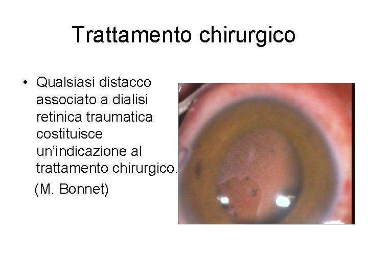 Trattamento chirurgico • Qualsiasi distacco associato a dialisi retinica traumatica costituisce un’indicazione al trattamento