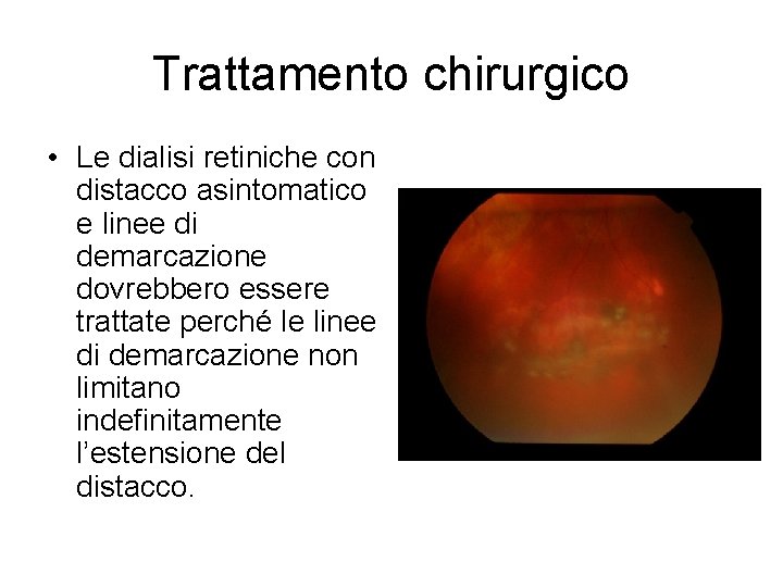 Trattamento chirurgico • Le dialisi retiniche con distacco asintomatico e linee di demarcazione dovrebbero