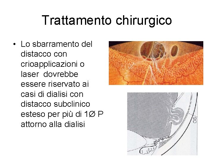 Trattamento chirurgico • Lo sbarramento del distacco con crioapplicazioni o laser dovrebbe essere riservato