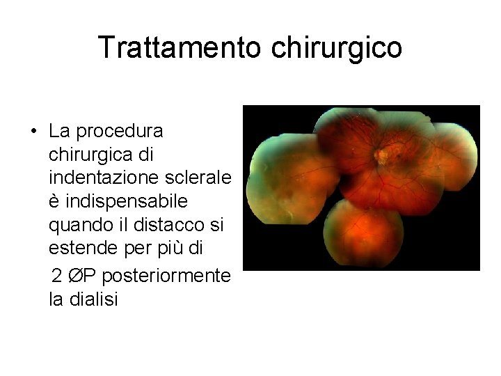 Trattamento chirurgico • La procedura chirurgica di indentazione sclerale è indispensabile quando il distacco