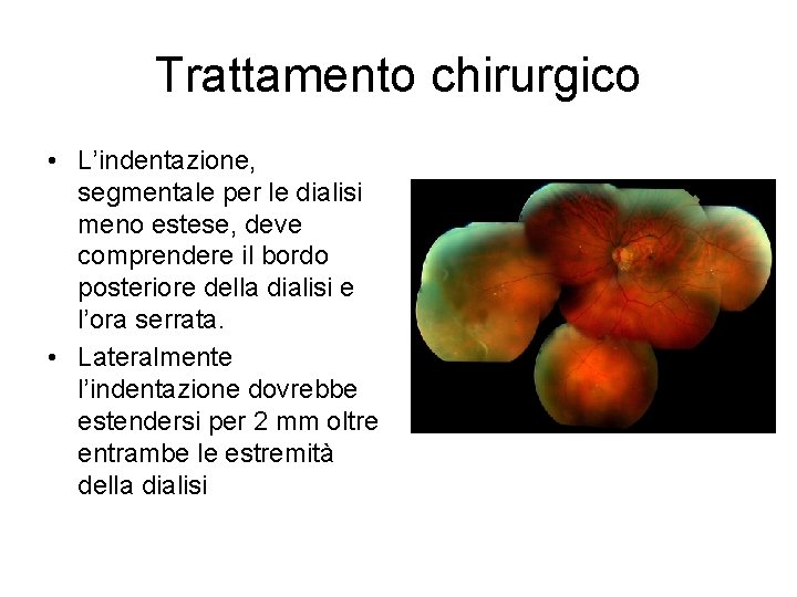 Trattamento chirurgico • L’indentazione, segmentale per le dialisi meno estese, deve comprendere il bordo