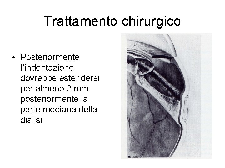 Trattamento chirurgico • Posteriormente l’indentazione dovrebbe estendersi per almeno 2 mm posteriormente la parte