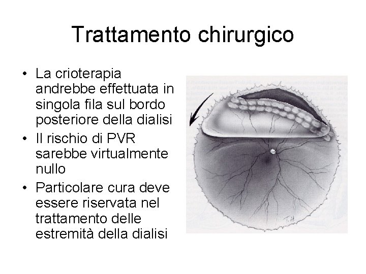 Trattamento chirurgico • La crioterapia andrebbe effettuata in singola fila sul bordo posteriore della