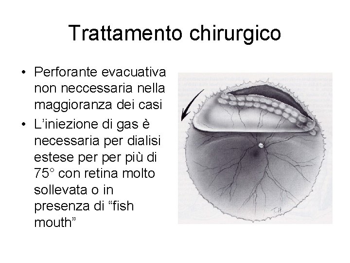 Trattamento chirurgico • Perforante evacuativa non neccessaria nella maggioranza dei casi • L’iniezione di