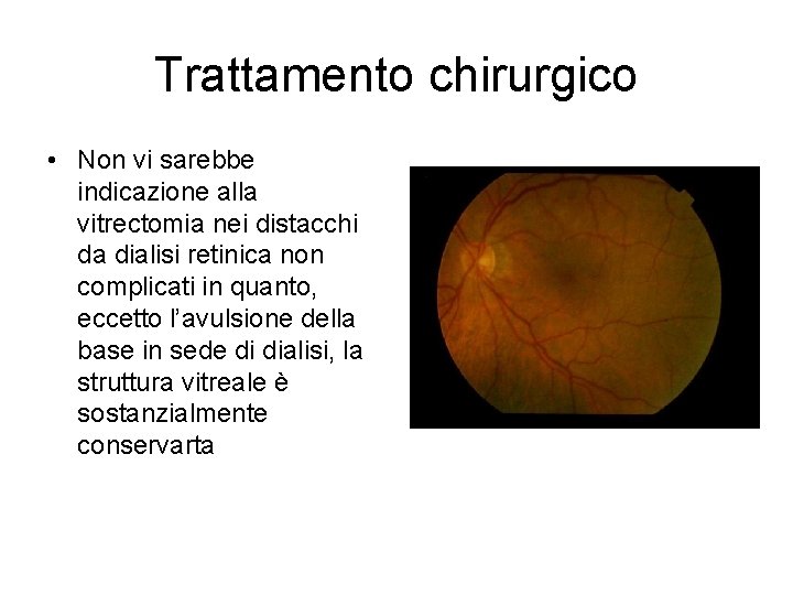 Trattamento chirurgico • Non vi sarebbe indicazione alla vitrectomia nei distacchi da dialisi retinica