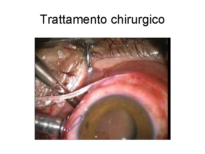 Trattamento chirurgico 
