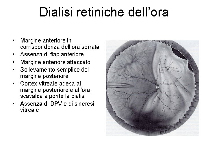 Dialisi retiniche dell’ora • Margine anteriore in corrispondenza dell’ora serrata • Assenza di flap