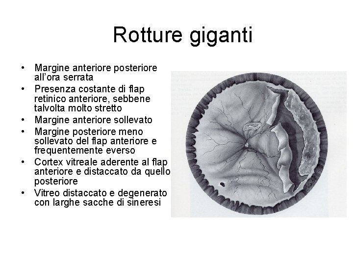 Rotture giganti • Margine anteriore posteriore all’ora serrata • Presenza costante di flap retinico