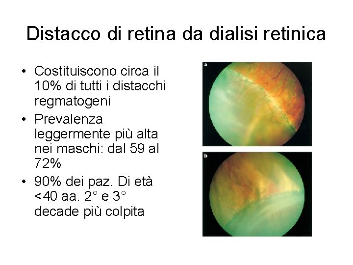 Distacco di retina da dialisi retinica • Costituiscono circa il 10% di tutti i