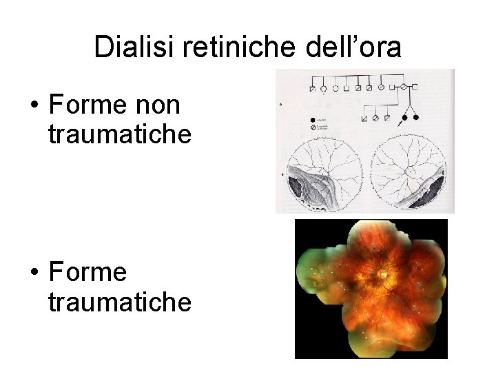 Dialisi retiniche dell’ora • Forme non traumatiche • Forme traumatiche 