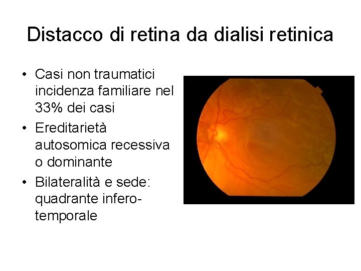 Distacco di retina da dialisi retinica • Casi non traumatici incidenza familiare nel 33%