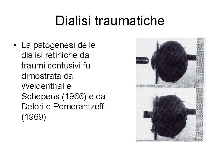 Dialisi traumatiche • La patogenesi delle dialisi retiniche da traumi contusivi fu dimostrata da