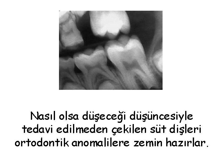 Nasıl olsa düşeceği düşüncesiyle tedavi edilmeden çekilen süt dişleri ortodontik anomalilere zemin hazırlar. 