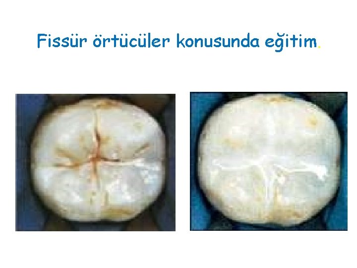 Fissür örtücüler konusunda eğitim. 