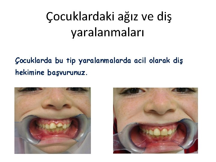 Çocuklardaki ağız ve diş yaralanmaları Çocuklarda bu tip yaralanmalarda acil olarak diş hekimine başvurunuz.