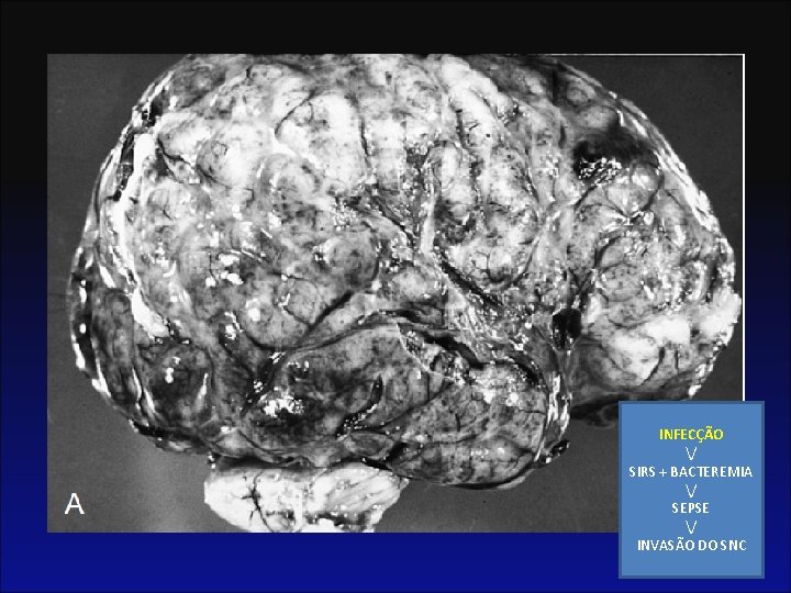 INFECÇÃO / SIRS + BACTEREMIA / SEPSE / INVASÃO DO SNC 