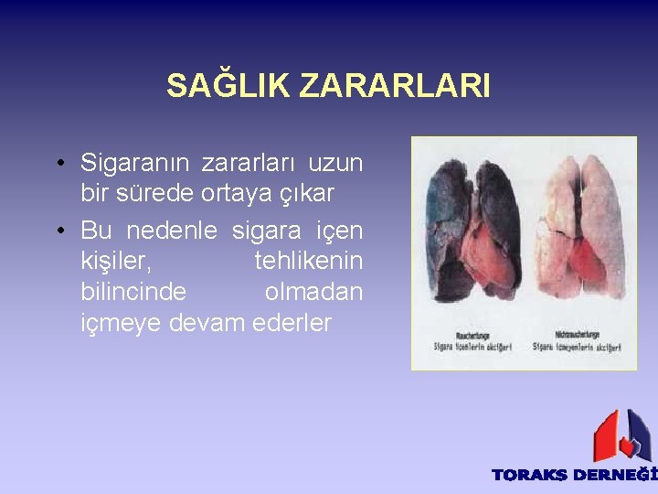 SAĞLIK ZARARLARI • Sigaranın zararları uzun bir sürede ortaya çıkar • Bu nedenle sigara