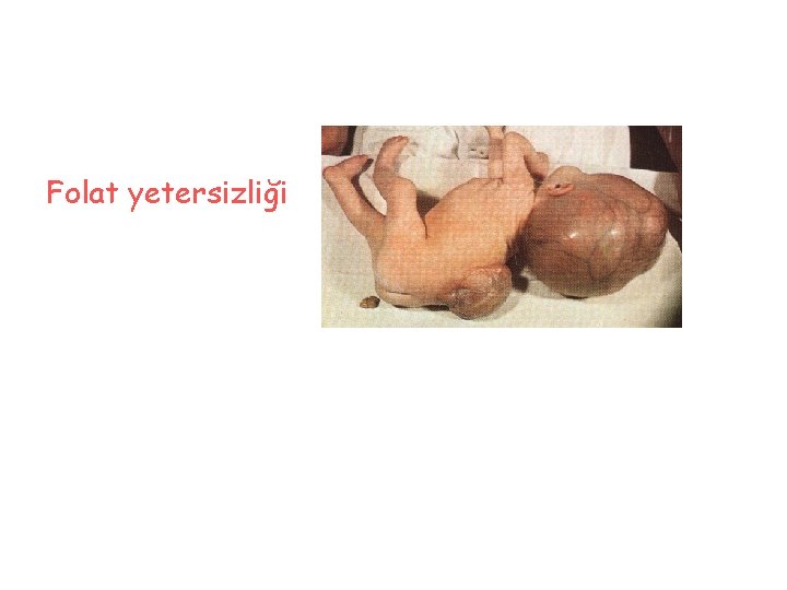 Folat yetersizliği 