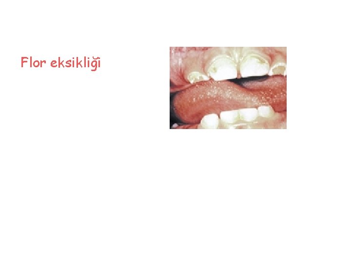 Flor eksikliği 