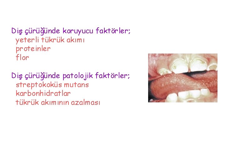 Diş çürüğünde koruyucu faktörler; yeterli tükrük akımı proteinler flor Diş çürüğünde patolojik faktörler; streptokoküs