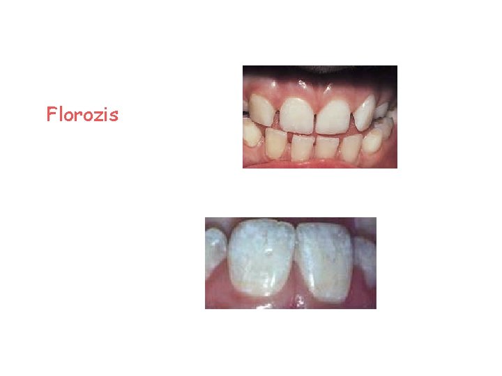 Florozis 