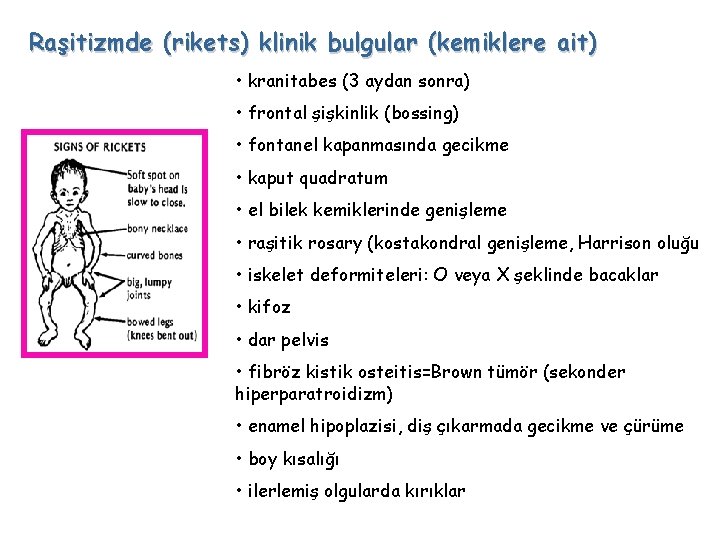 Raşitizmde (rikets) klinik bulgular (kemiklere ait) • kranitabes (3 aydan sonra) • frontal şişkinlik