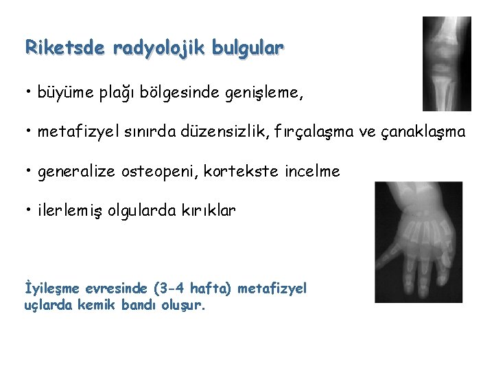 Riketsde radyolojik bulgular • büyüme plağı bölgesinde genişleme, • metafizyel sınırda düzensizlik, fırçalaşma ve
