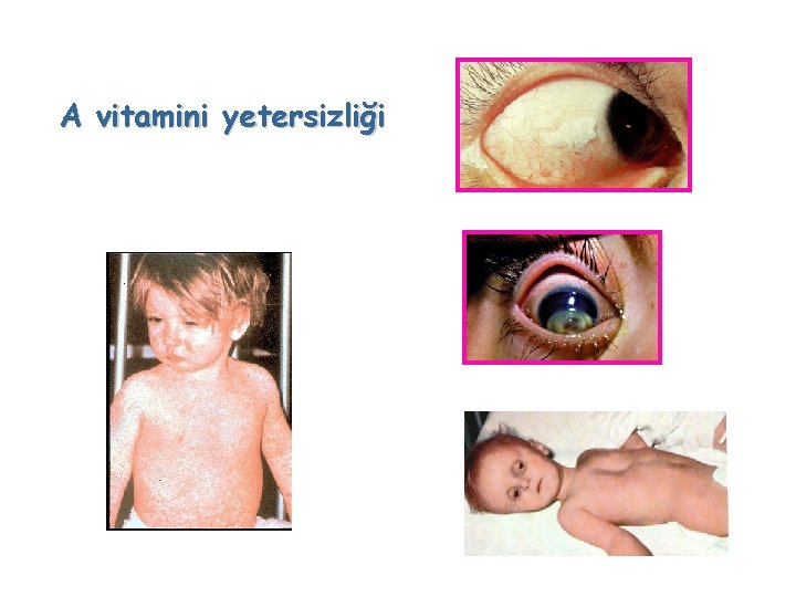 A vitamini yetersizliği 