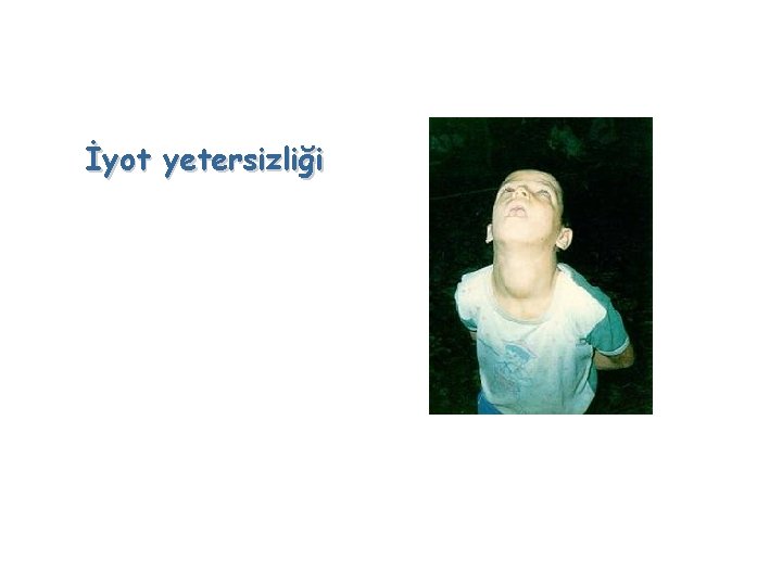 İyot yetersizliği 