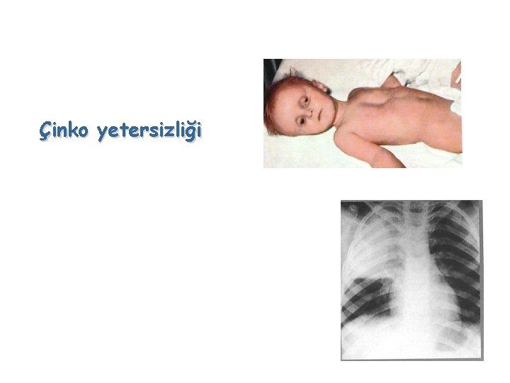 Çinko yetersizliği 