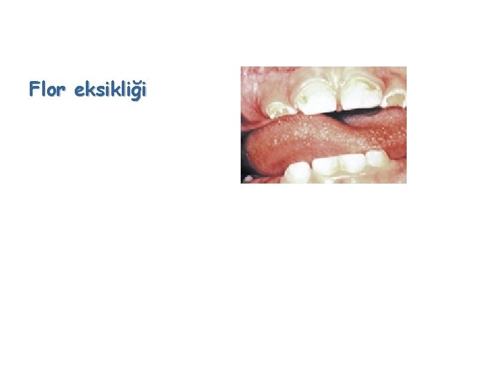 Flor eksikliği 