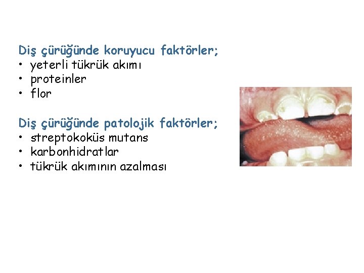 Diş çürüğünde koruyucu faktörler; • yeterli tükrük akımı • proteinler • flor Diş çürüğünde